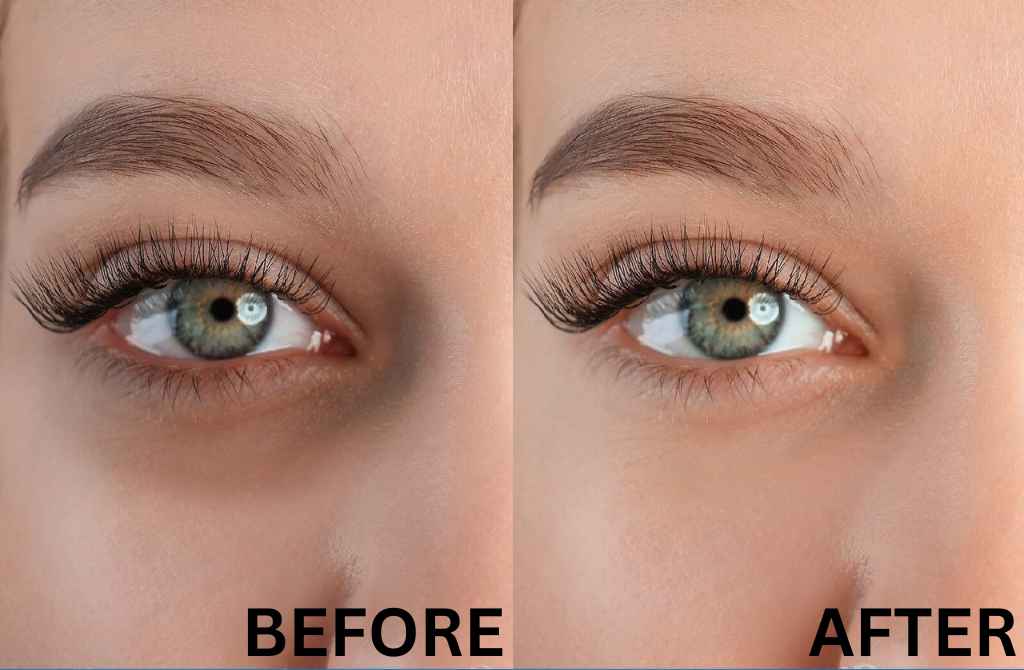Best Treatments for Dark Circles, offered at Twacha Aesthetic Clinic