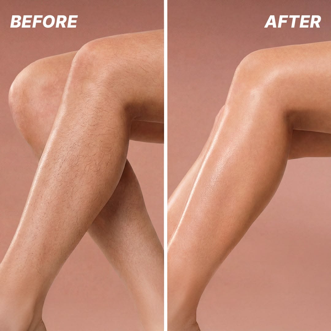 Laser Hair Removal Before After Results
