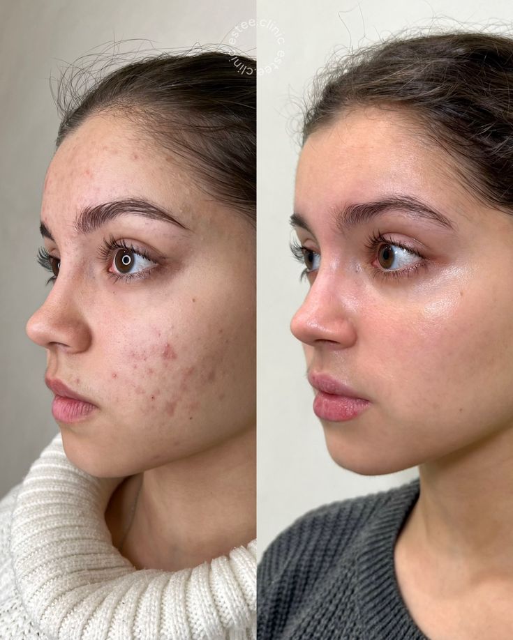 Scar and Open Pores Treatment Before After Results