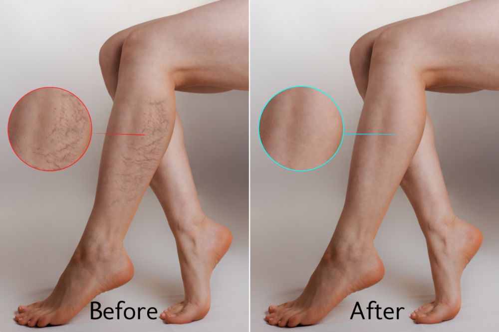 Spider Vein Removal Before After Result