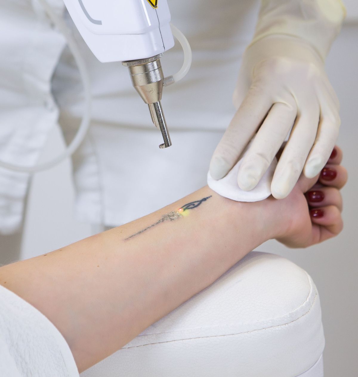 Tattoo Removal Before After Results