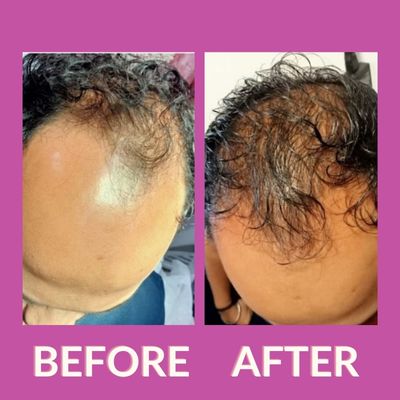 Hair PRP Treatment- Twacha Aesthetic Clinic
