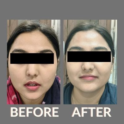 Skin Whitening Treatment - Twacha Aesthetic Clinic