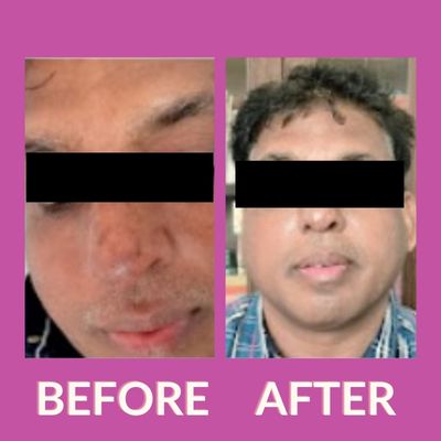 Skin Whitening Treatment- Twacha Aesthetic Clinic