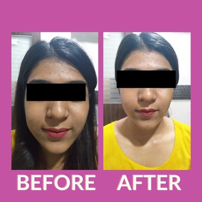 Skin Whitening