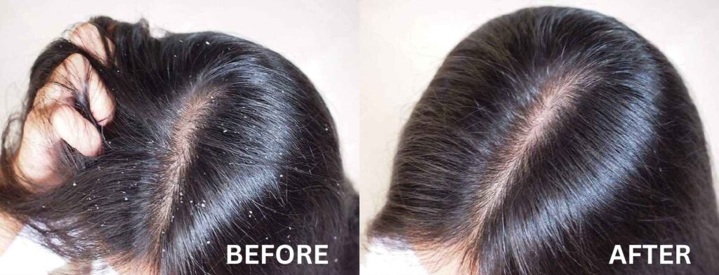 3 steps is all it takes for 95% Dandruff free hair with Krone Anti Dandruff  Kit! Flaunt strong and luscious hair with a healthy scalp. Be the change  with... | By KroneProfessional | Facebook