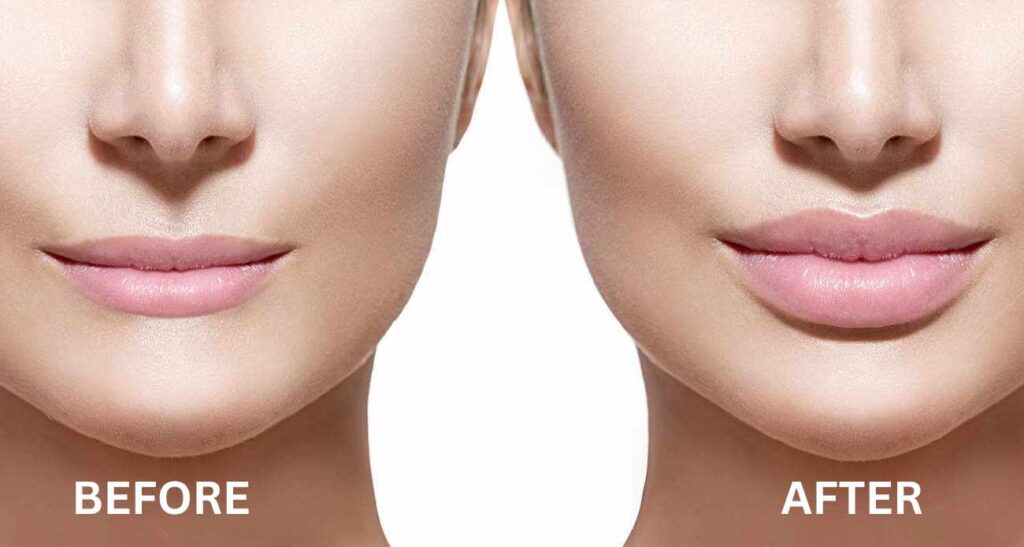 Lip Fillers Treatment - Twacha Aesthetic Clinic, Nagpur