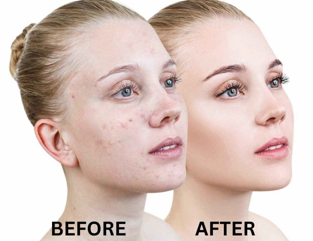 acne rosacea vs acne vulgaris
