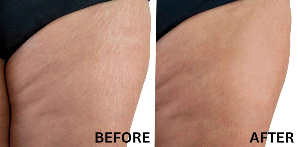Best Treatments to get rid of Stretch Marks in India