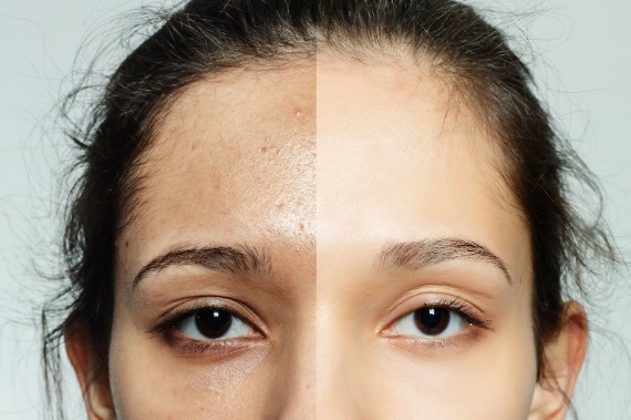 Top 7 reasons for HydraFacial