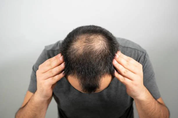 hair fall