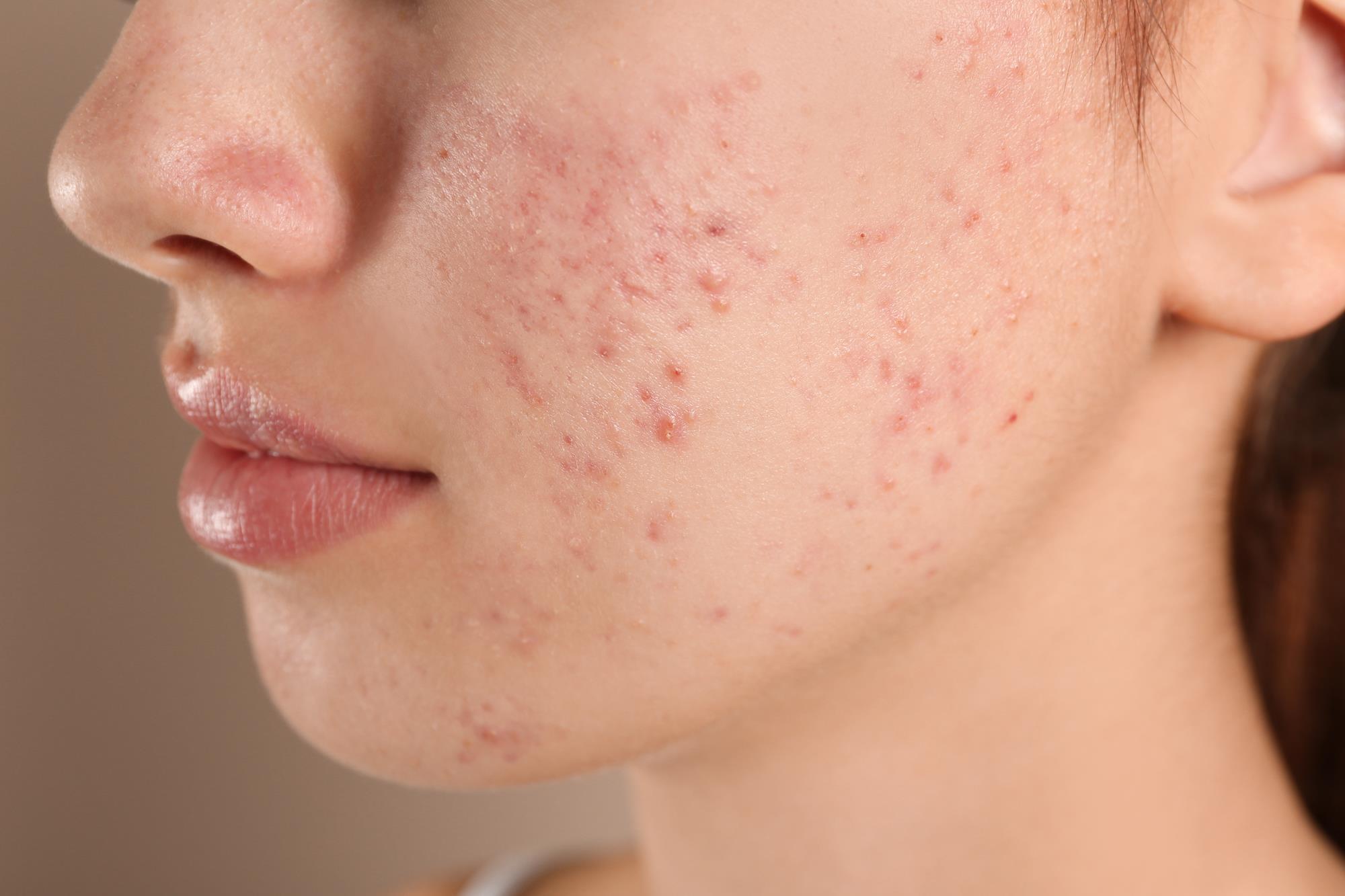 Acne Treatment In Nagpur
