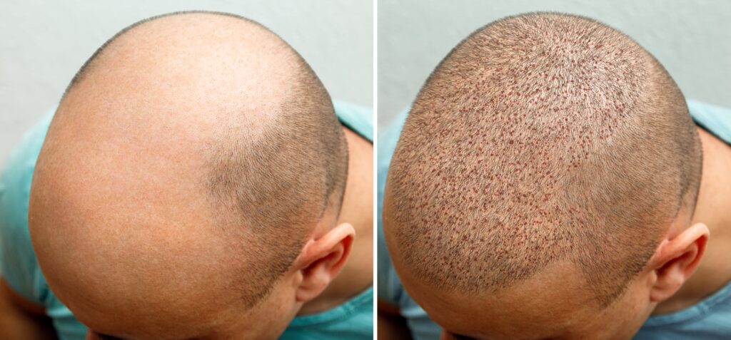 Best Hair Transplant Clinic In Nagpur