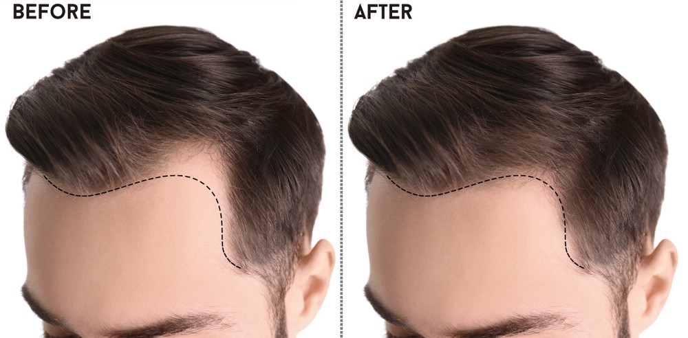 Best Hair Transplant Specialist