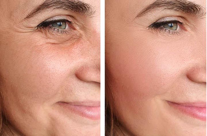 Face Lifting Treatment In Nagpur