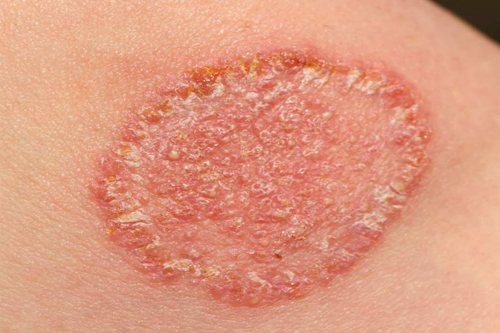 Fungal Infection Treatment In Nagpur