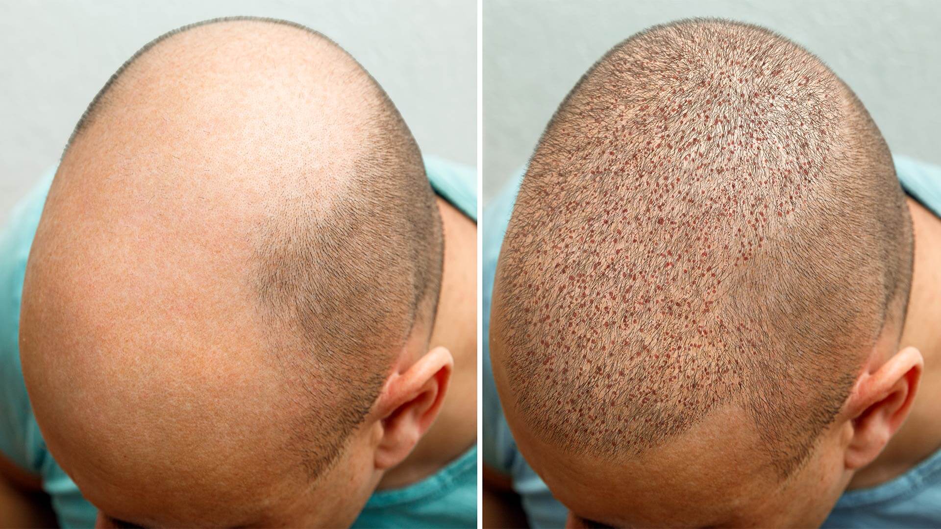 Hair Transplant In Nagpur