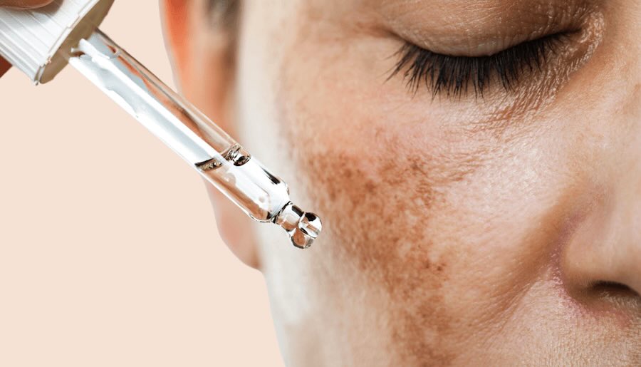 Melasma Treatment In Nagpur