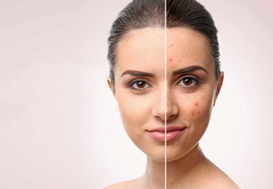 Scar Removal Treatment In Nagpur