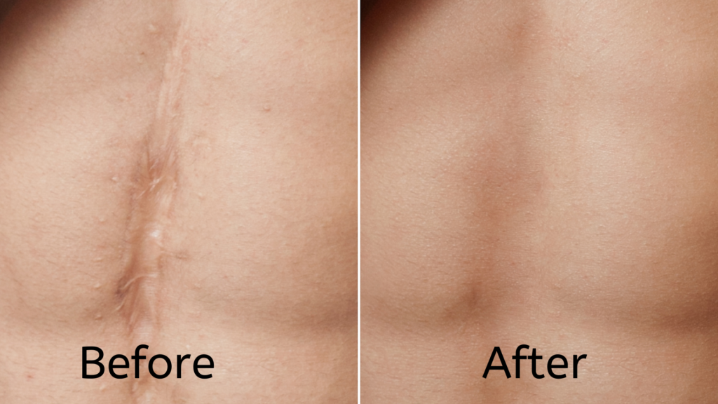 Scar Removal by Laser Treatment In Nagpur