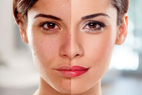 Skin Whitening Treatment In Nagpur