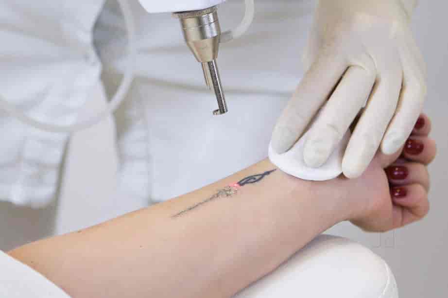 Tattoo Removal in Nagpur