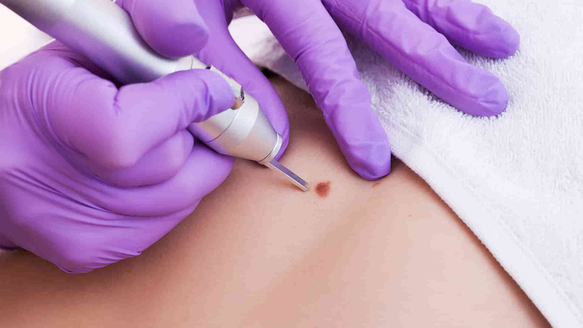 Wart Removal by Laser Treatment In Nagpur